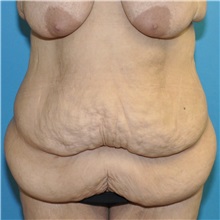 Body Lift Before Photo by Joshua Cooper, MD, FACS; SEATTLE, WA - Case 51608