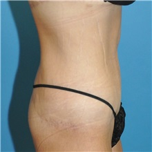 Body Lift After Photo by Joshua Cooper, MD, FACS; SEATTLE, WA - Case 51608