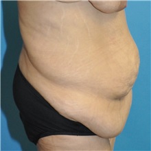 Body Lift Before Photo by Joshua Cooper, MD, FACS; SEATTLE, WA - Case 51608
