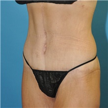 Body Lift After Photo by Joshua Cooper, MD, FACS; SEATTLE, WA - Case 51608