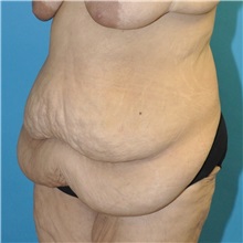 Body Lift Before Photo by Joshua Cooper, MD, FACS; SEATTLE, WA - Case 51608