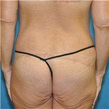 Body Lift After Photo by Joshua Cooper, MD, FACS; SEATTLE, WA - Case 51608