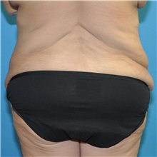 Body Lift Before Photo by Joshua Cooper, MD, FACS; SEATTLE, WA - Case 51608