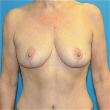 Breast Reduction After Photo by Joshua Cooper, MD; Seattle, WA - Case 49839