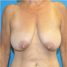 Breast Reduction Before Photo by Joshua Cooper, MD; Seattle, WA - Case 49839