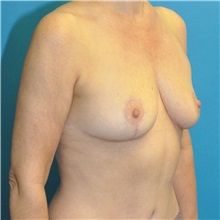 Breast Reduction After Photo by Joshua Cooper, MD; Seattle, WA - Case 49839