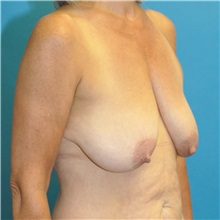 Breast Reduction Before Photo by Joshua Cooper, MD; Seattle, WA - Case 49839