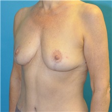 Breast Reduction After Photo by Joshua Cooper, MD; Seattle, WA - Case 49839