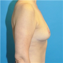 Breast Reduction After Photo by Joshua Cooper, MD; Seattle, WA - Case 49839