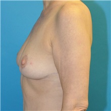 Breast Reduction After Photo by Joshua Cooper, MD; Seattle, WA - Case 49839