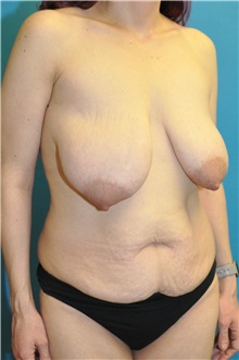Mommy Makeover Before Photo by Joshua Cooper, MD; Seattle, WA - Case 50068