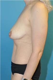 Mommy Makeover After Photo by Joshua Cooper, MD; Seattle, WA - Case 50068