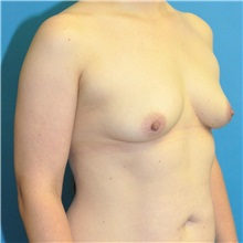 Breast Augmentation Before Photo by Joshua Cooper, MD; Seattle, WA - Case 50069