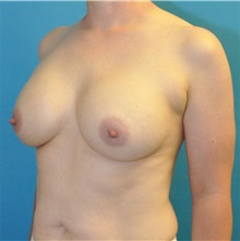 Breast Augmentation After Photo by Joshua Cooper, MD; Seattle, WA - Case 50069