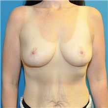 Breast Reduction After Photo by Joshua Cooper, MD; Seattle, WA - Case 50081 Breast Reduction After Photo by Joshua Cooper, MD; Seattle, WA - Case 50081