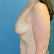 Breast Reduction After Photo by Joshua Cooper, MD; Seattle, WA - Case 50081