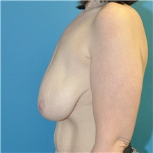 Breast Reduction Before Photo by Joshua Cooper, MD; Seattle, WA - Case 50081
