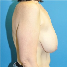 Breast Reduction Before Photo by Joshua Cooper, MD; Seattle, WA - Case 50081