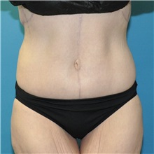 Body Lift After Photo by Joshua Cooper, MD; Seattle, WA - Case 50083 Body Lift After Photo by Joshua Cooper, MD; Seattle, WA - Case 50083