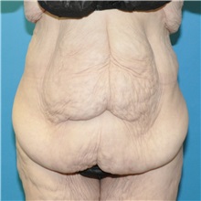 Body Lift Before Photo by Joshua Cooper, MD; Seattle, WA - Case 50083 Body Lift Before Photo by Joshua Cooper, MD; Seattle, WA - Case 50083