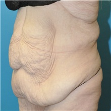 Body Lift Before Photo by Joshua Cooper, MD; Seattle, WA - Case 50083