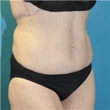 Body Lift After Photo by Joshua Cooper, MD; Seattle, WA - Case 50083