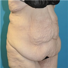 Body Lift Before Photo by Joshua Cooper, MD; Seattle, WA - Case 50083