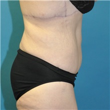 Body Lift After Photo by Joshua Cooper, MD; Seattle, WA - Case 50083