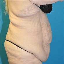 Body Lift Before Photo by Joshua Cooper, MD; Seattle, WA - Case 50083
