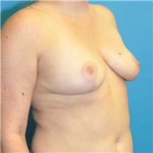 Breast Reduction After Photo by Joshua Cooper, MD; Seattle, WA - Case 50141
