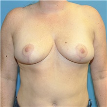 Breast Reduction After Photo by Joshua Cooper, MD; Seattle, WA - Case 50141