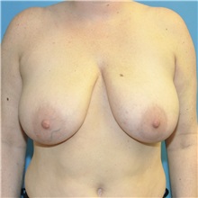 Breast Reduction Before Photo by Joshua Cooper, MD; Seattle, WA - Case 50141