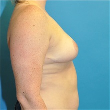 Breast Reduction After Photo by Joshua Cooper, MD; Seattle, WA - Case 50141