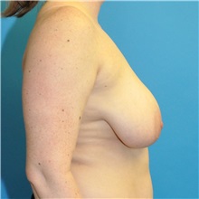 Breast Reduction Before Photo by Joshua Cooper, MD; Seattle, WA - Case 50141
