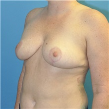 Breast Reduction After Photo by Joshua Cooper, MD; Seattle, WA - Case 50141