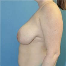 Breast Reduction Before Photo by Joshua Cooper, MD; Seattle, WA - Case 50141