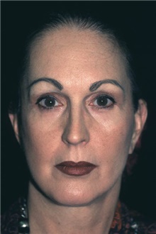 Facelift After Photo by Bahman Guyuron, MD; Cleveland, OH - Case 3353