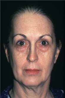 Facelift Before Photo by Bahman Guyuron, MD; Cleveland, OH - Case 3353