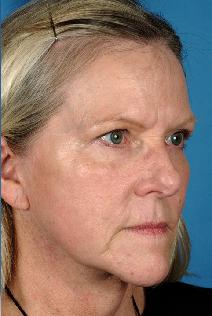 Facelift After Photo by Bahman Guyuron, MD; Cleveland, OH - Case 8380