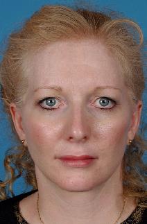 Facelift After Photo by Bahman Guyuron, MD; Cleveland, OH - Case 8385
