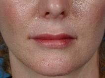 Facelift After Photo by Bahman Guyuron, MD; Cleveland, OH - Case 8385