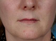 Facelift Before Photo by Bahman Guyuron, MD; Cleveland, OH - Case 8385