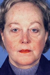 Facelift After Photo by Bahman Guyuron, MD; Cleveland, OH - Case 8386