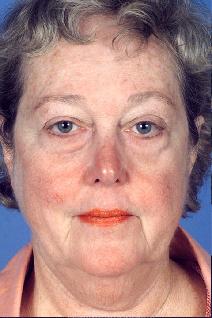 Facelift Before Photo by Bahman Guyuron, MD; Cleveland, OH - Case 8386