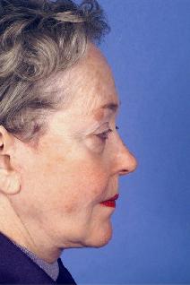 Facelift After Photo by Bahman Guyuron, MD; Cleveland, OH - Case 8386