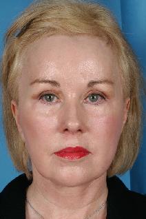 Facelift After Photo by Bahman Guyuron, MD; Cleveland, OH - Case 8387