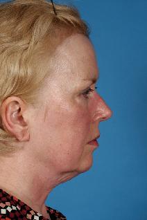 Facelift Before Photo by Bahman Guyuron, MD; Cleveland, OH - Case 8387