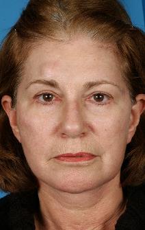 Facelift After Photo by Bahman Guyuron, MD; Cleveland, OH - Case 8388