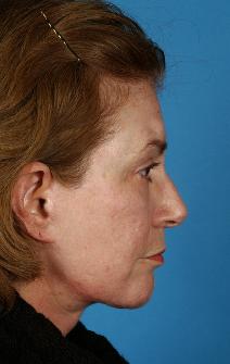 Facelift After Photo by Bahman Guyuron, MD; Cleveland, OH - Case 8388