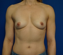 Breast Augmentation Before Photo by Steven Camp, MD; Fort Worth, TX - Case 47146